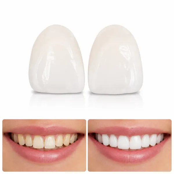 Kit com 2 Placas Dentais de Cerâmica Brancas PARA TODAS ARCARIAS